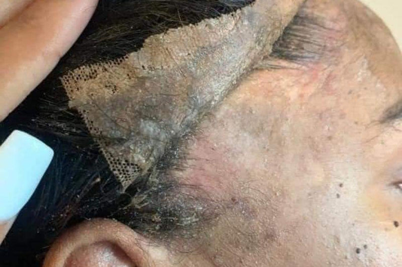 How Dangerous is Lace Glue?